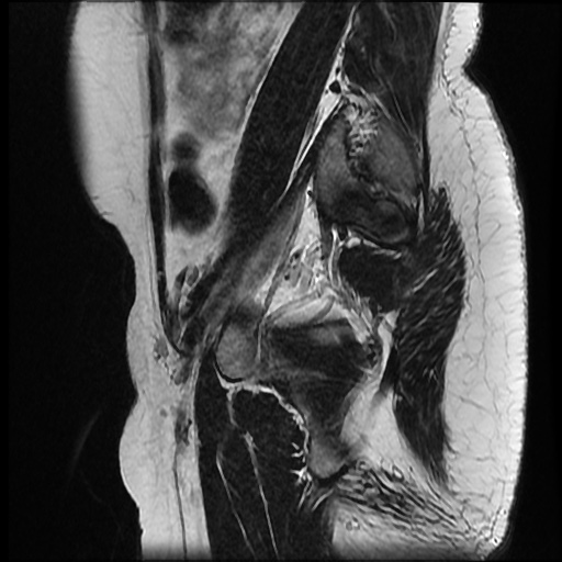 File:Bicornuate uterus (Radiopaedia 51676-57472 Sagittal T2 22).jpg