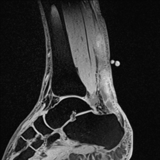 Bilateral Achilles tendon complete tear (Radiopaedia 81344-95051 Sagittal WE - Left 57).jpg