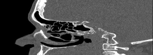 Bilateral Ectopic Infraorbital Nerves (Radiopaedia 49006-54084 Sagittal bone window 30).jpg