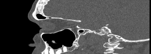 File:Bilateral Ectopic Infraorbital Nerves (Radiopaedia 49006-54084 Sagittal bone window 35).jpg