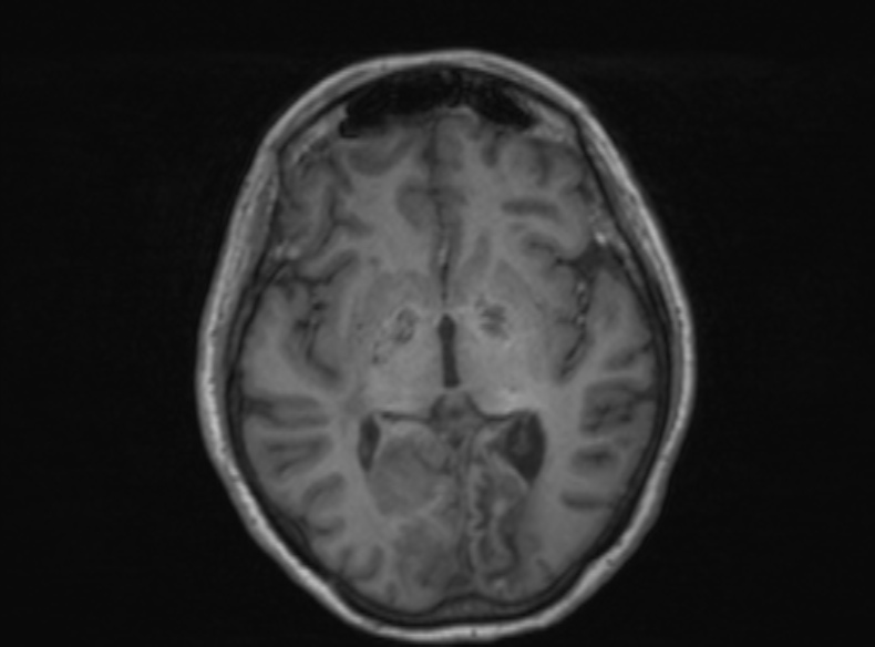 Bilateral PCA territory infarction - different ages (Radiopaedia 46200-51784 Axial T1 243).jpg