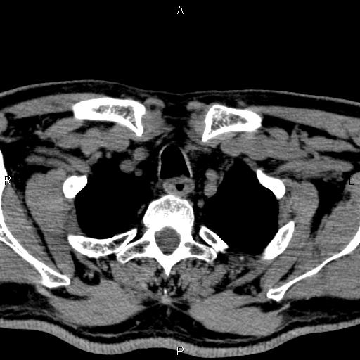 Bilateral Warthin tumors (Radiopaedia 84034-99263 Axial non-contrast 61).jpg