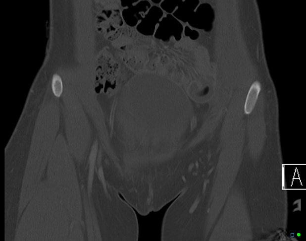 File:Bilateral acetabular fractures (Radiopaedia 79272-92308 Coronal bone window 2).jpg
