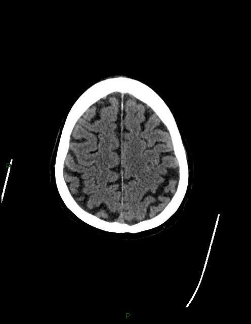 Bilateral acute middle cerebral artery territory infarcts (Radiopaedia 77319-89401 Axial non-contrast 72).jpg
