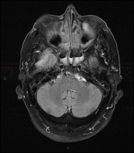 File:Bilateral acute middle cerebral artery territory infarcts (Radiopaedia 77319-89402 Axial FLAIR 6).jpg