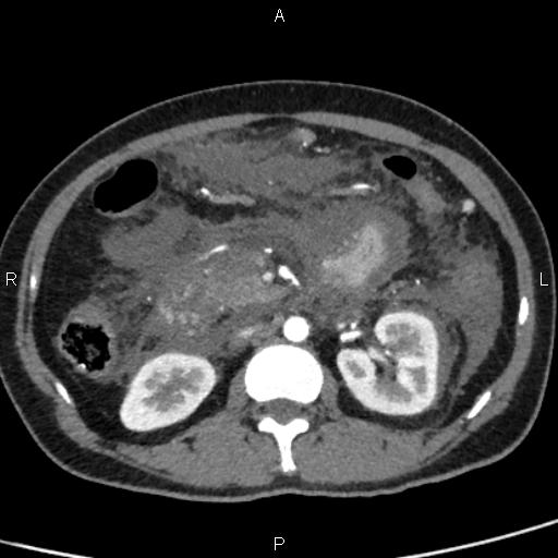 Bilateral adrenal gland hyperenhancement in pancreatitis (Radiopaedia 86642-102753 B 61).jpg