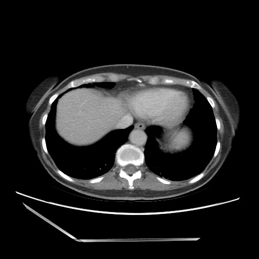 File:Bilateral adrenal granulocytic sarcomas (chloromas) (Radiopaedia 78375-91007 Axial 107).jpg