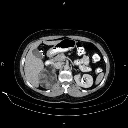 Bilateral adrenal myelolipoma (Radiopaedia 63058-71535 Axial C+ delayed 35).jpg
