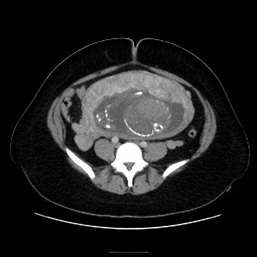Bilateral adrenal thrombosis (Radiopaedia 58182-65256 A 51).jpg