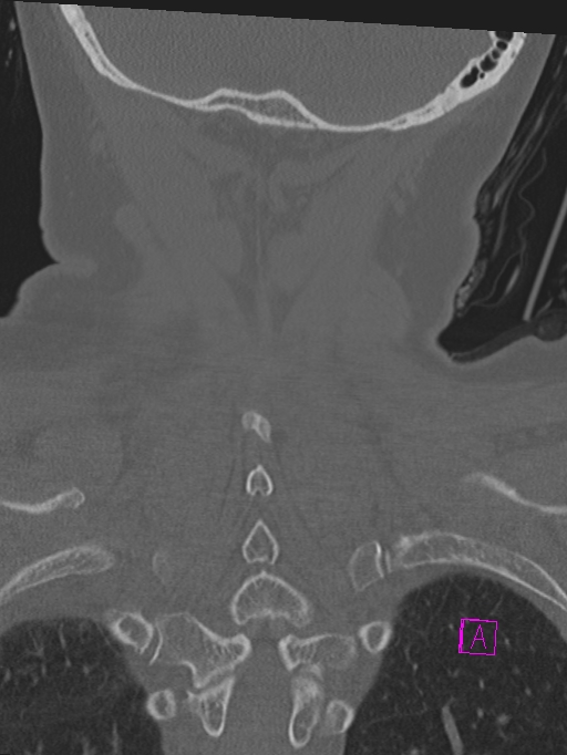 Bilateral atlanto-occipital assimilation (Radiopaedia 28350-28603 Coronal bone window 42).jpg