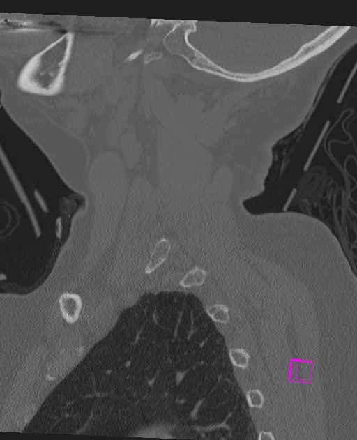 Bilateral atlanto-occipital assimilation (Radiopaedia 28350-28603 Sagittal bone window 15).jpg
