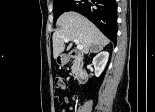 Bilateral benign adrenal adenomas (Radiopaedia 86912-103124 E 36).jpg