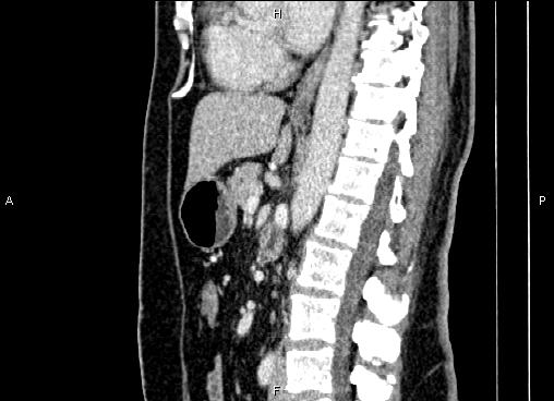Bilateral benign adrenal adenomas (Radiopaedia 86912-103124 E 52).jpg