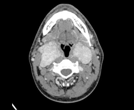 File:Bilateral carotid body tumors (Radiopaedia 61841-69870 Axial Post contrast 45).jpg