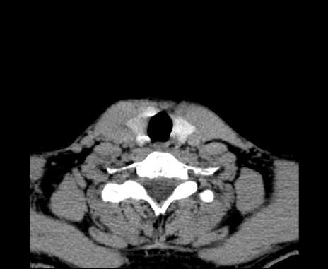 Bilateral carotid body tumors (Radiopaedia 61841-69870 Axial non-contrast 90).jpg