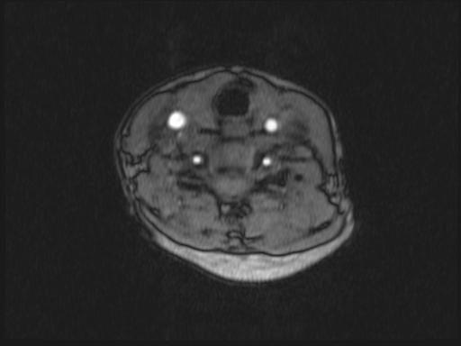 Bilateral carotid body tumors and right glomus jugulare tumor (Radiopaedia 20024-20060 Axial MRA 223).jpg