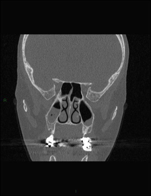 Bilateral frontal mucoceles (Radiopaedia 82352-96454 Coronal 183).jpg