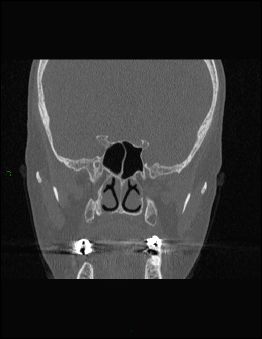 Bilateral frontal mucoceles (Radiopaedia 82352-96454 Coronal 201).jpg