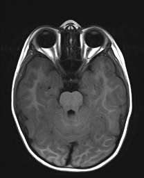 File:Bilateral mesial temporal polymicrogyria (Radiopaedia 76456-88181 Axial T1 8).jpg