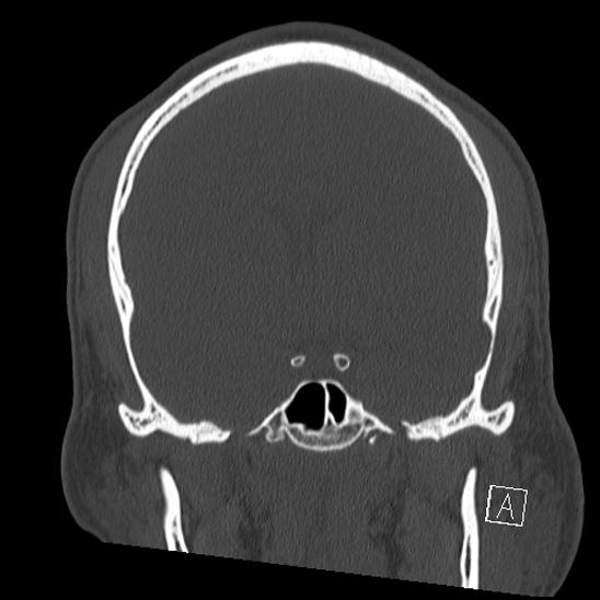 Bilateral occipital condyle fracture (type 2) (Radiopaedia 87675-104089 Coronal bone window 54).jpg