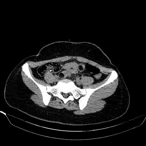 File:Bilateral ovarian dermoid (Radiopaedia 45714-49907 Axial non-contrast 9).JPEG