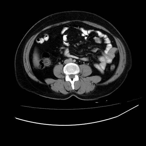 File:Bilateral ovarian dermoid cysts (Radiopaedia 51336).jpg