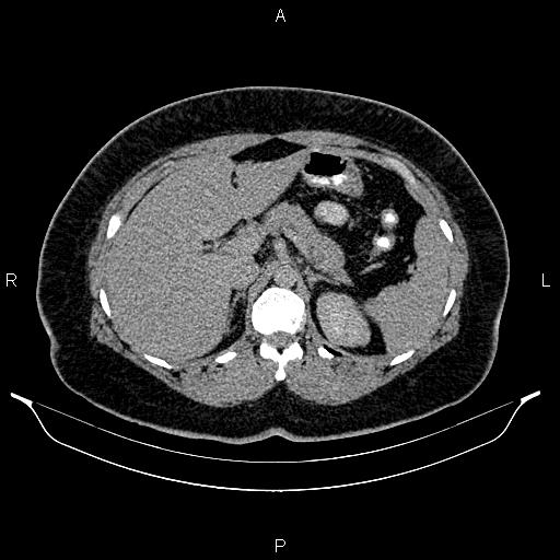 Bilateral ovarian dermoid cysts (Radiopaedia 85785-101603 Axial C+ delayed 16).jpg