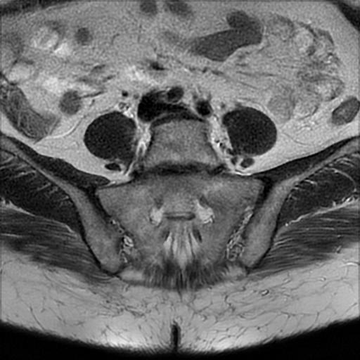File:Bilateral ovarian dermoid cysts (Radiopaedia 90152-107338 Axial T2 1).jpg