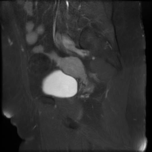 File:Bilateral ovarian dermoid cysts (Radiopaedia 90152-107338 Sagittal T1 C+ 18).jpg