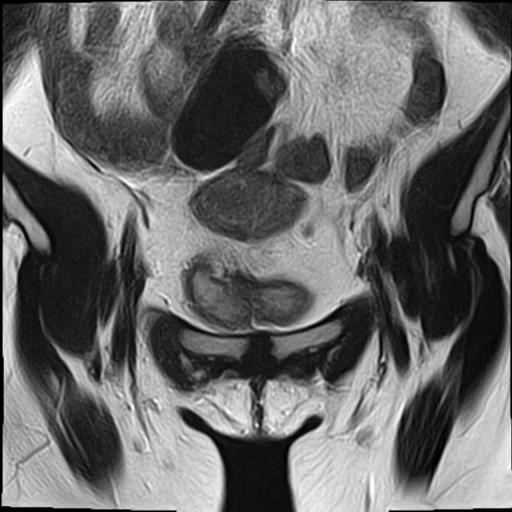 File:Bilateral ovarian endometriomas (Radiopaedia 87085-103347 Coronal T2 4).jpg