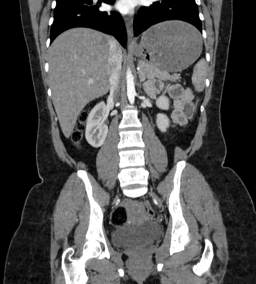 Bilateral ovarian mature cystic teratomas (Radiopaedia 79373-92457 B 47).jpg