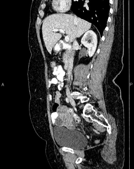 Bilateral ovarian serous cystadenocarcinoma (Radiopaedia 86062-101989 E 31).jpg