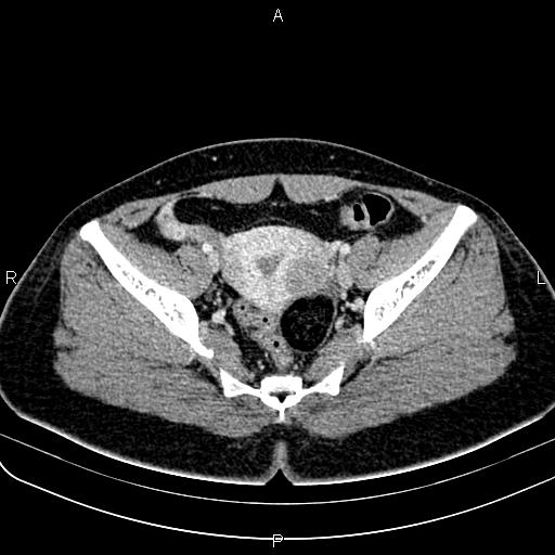 File:Bilateral ovarian teratoma (Radiopaedia 83131-97503 Axial With contrast 40).jpg