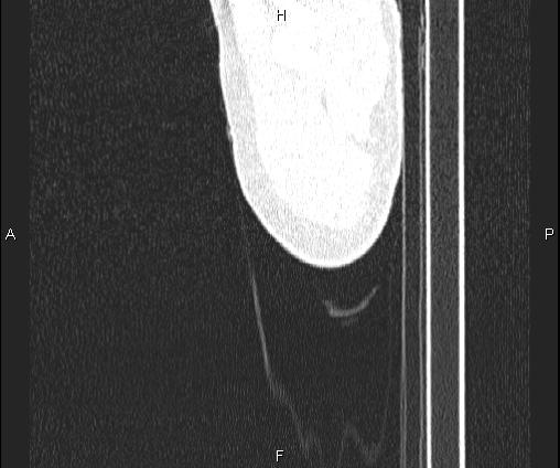 Bilateral pulmonary AVM (Radiopaedia 83134-97505 Sagittal lung window 2).jpg