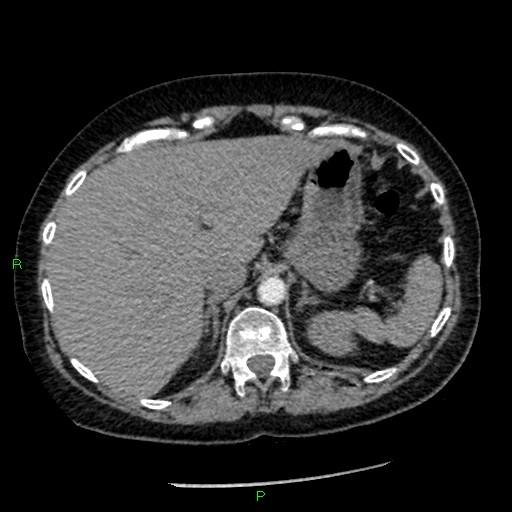 Bilateral pulmonary emboli (Radiopaedia 32700-33669 Axial C+ CTPA 102).jpg