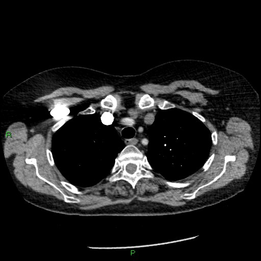 Bilateral pulmonary emboli (Radiopaedia 32700-33669 Axial C+ CTPA 22).jpg