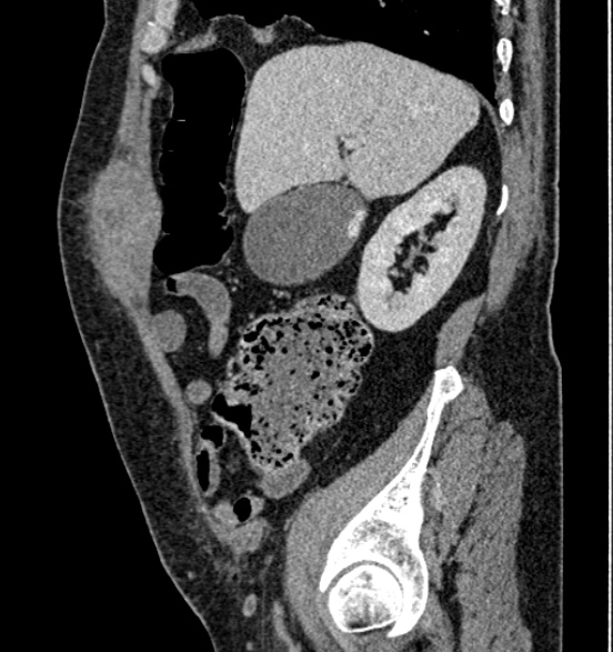 Bilateral rectus sheath hematomas (Radiopaedia 50778-56252 B 24).jpg