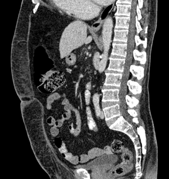 File:Bilateral rectus sheath hematomas (Radiopaedia 50778-56252 B 42).jpg
