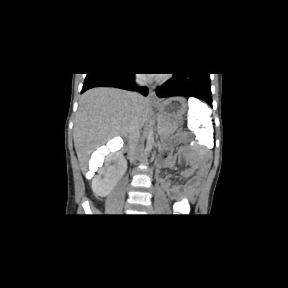 File:Bilateral renal malrotation (Radiopaedia 30901-31606 B 22).jpg