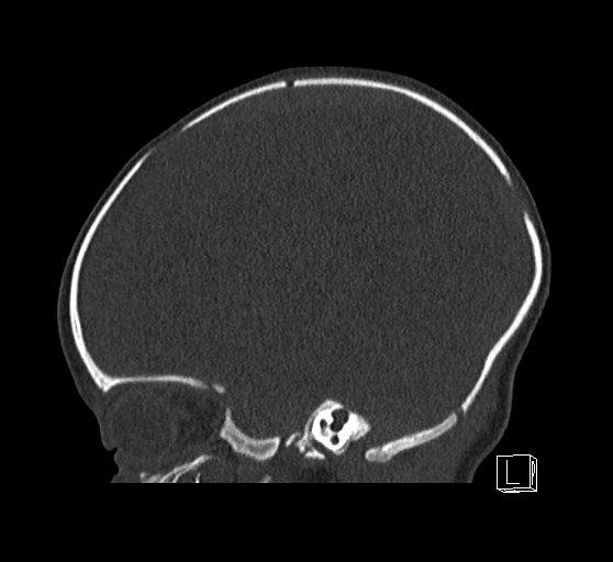 Bilateral subdural hemorrhage and parietal skull fracture (Radiopaedia 26058-26192 Sagittal bone window 65).png