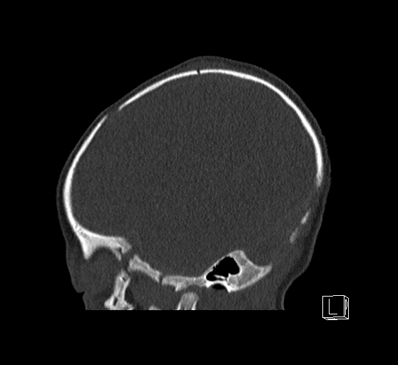 Bilateral subdural hemorrhage and parietal skull fracture (Radiopaedia 26058-26192 Sagittal bone window 78).png