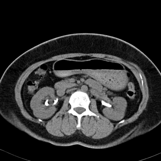 Bilateral ureteric stents (Radiopaedia 48795-53825 Axial non-contrast 23).jpg