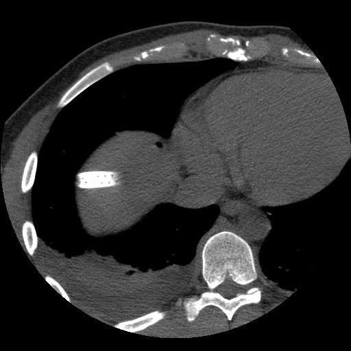 Bile leak from liver traumatic laceration (Radiopaedia 63463-72077 Axial Biliscopin 3).jpg