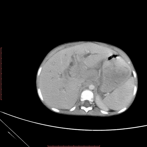 Biliary tract embryonal rhabdomyosarcoma (Radiopaedia 51815-57648 A 22).jpg