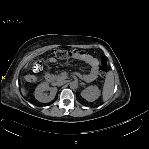 File:Biloma with drainage into the colon (Radiopaedia 20032-20068 B 16).jpg