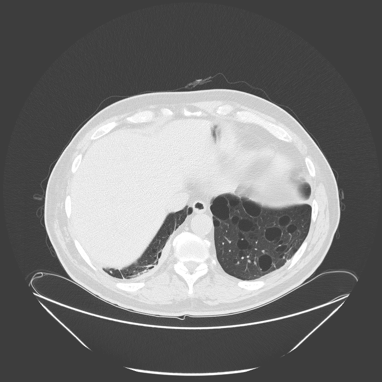 Birt-Hogg-Dubé syndrome (Radiopaedia 52578-58491 Axial lung window 52).jpg