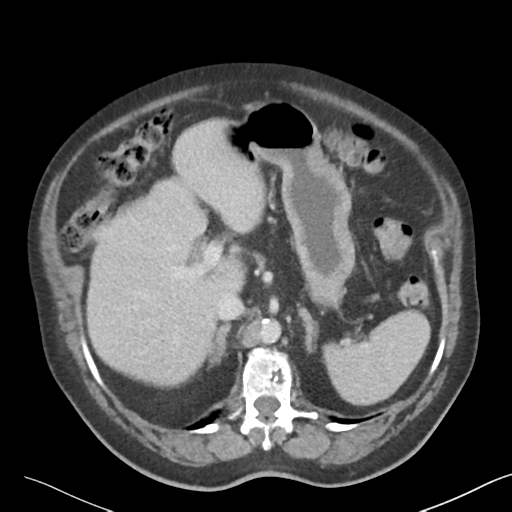 File:Bladder papillary urothelial carcinoma (Radiopaedia 48119-52951 Axial 12).png