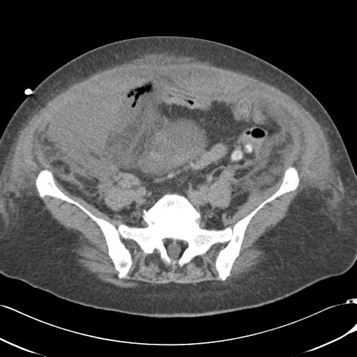 Bladder rupture post renal biopsy (Radiopaedia 30863-31572 Axial non-contrast 61).jpg