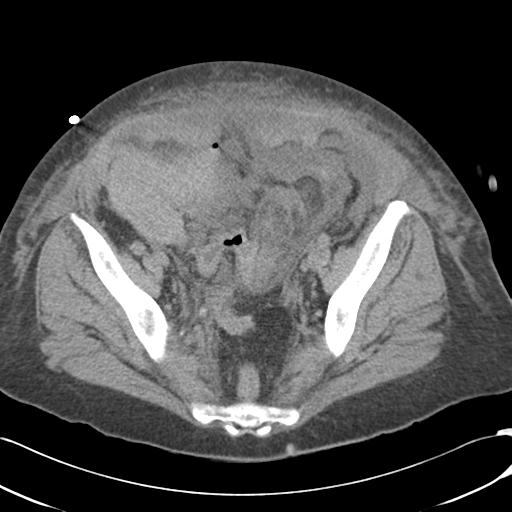 Bladder rupture post renal biopsy (Radiopaedia 30863-31572 Axial non-contrast 71).jpg