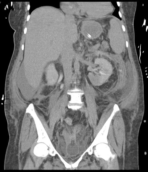 File:Bladder rupture post renal biopsy (Radiopaedia 30863-31572 Coronal non-contrast 33).jpg